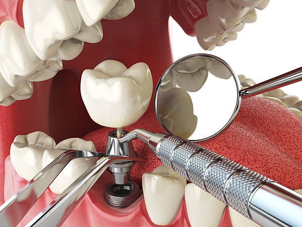 Best Emergency Dentist for Lost Fillings or Crowns in Asbury, IA